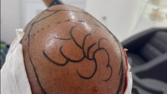 Hair Transplant From +5200 Graft